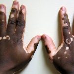 Serie A 2024-25: Inter Milan keeper Yann Sommer suffers thumb fracture