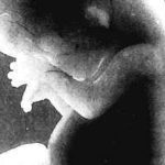 Researchers announce breakthrough in breast cancer care by using chromosomes to monitor treatment and predict recurrence Premium