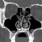 WHO adds GLP-1 drugs for diabetes, others to essential medicines list