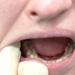 Meghalaya re-skills TB survivors, seeks their help as ‘TB champions’