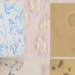 Govt panel rejects inclusion of 9 medical conditions in RPwD Act disability list